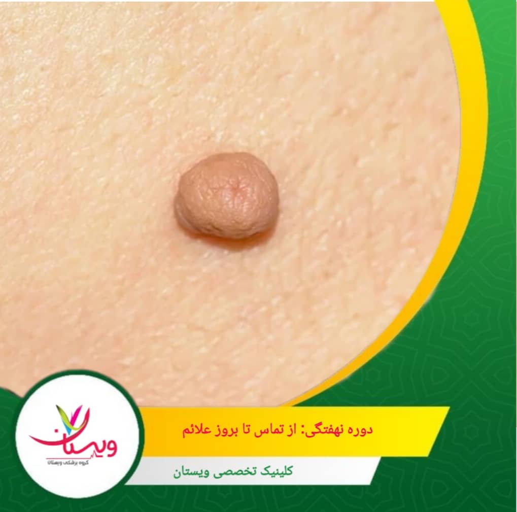 ویروس ممکن است در سلولهای پوست یا مخاط بهصورت نهفته باقی بماند تا زمانی که سیستم ایمنی ضعیف شود. دوره نهفتگی: از تماس تا بروز علائم