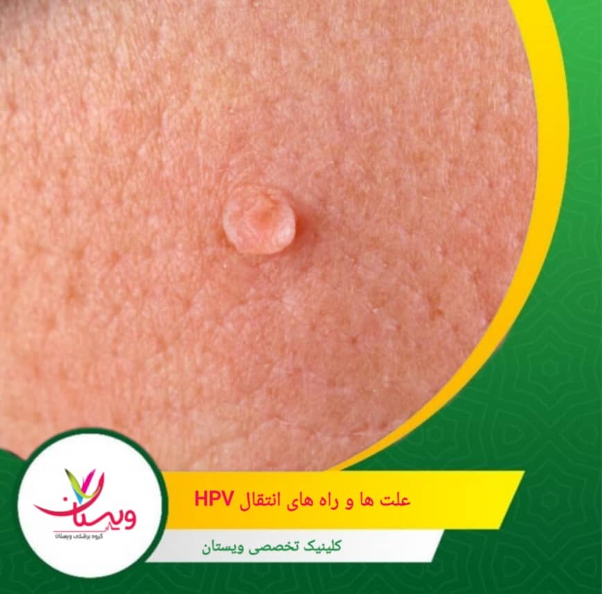 آلودگی دستها یا سطوح حاوی HPV امکان انتقال ویروس از یک ناحیه بدن به ناحیه دیگر را فراهم میکند—حتی بدون تماس جنسی. علتها و راههای انتقال HPV
