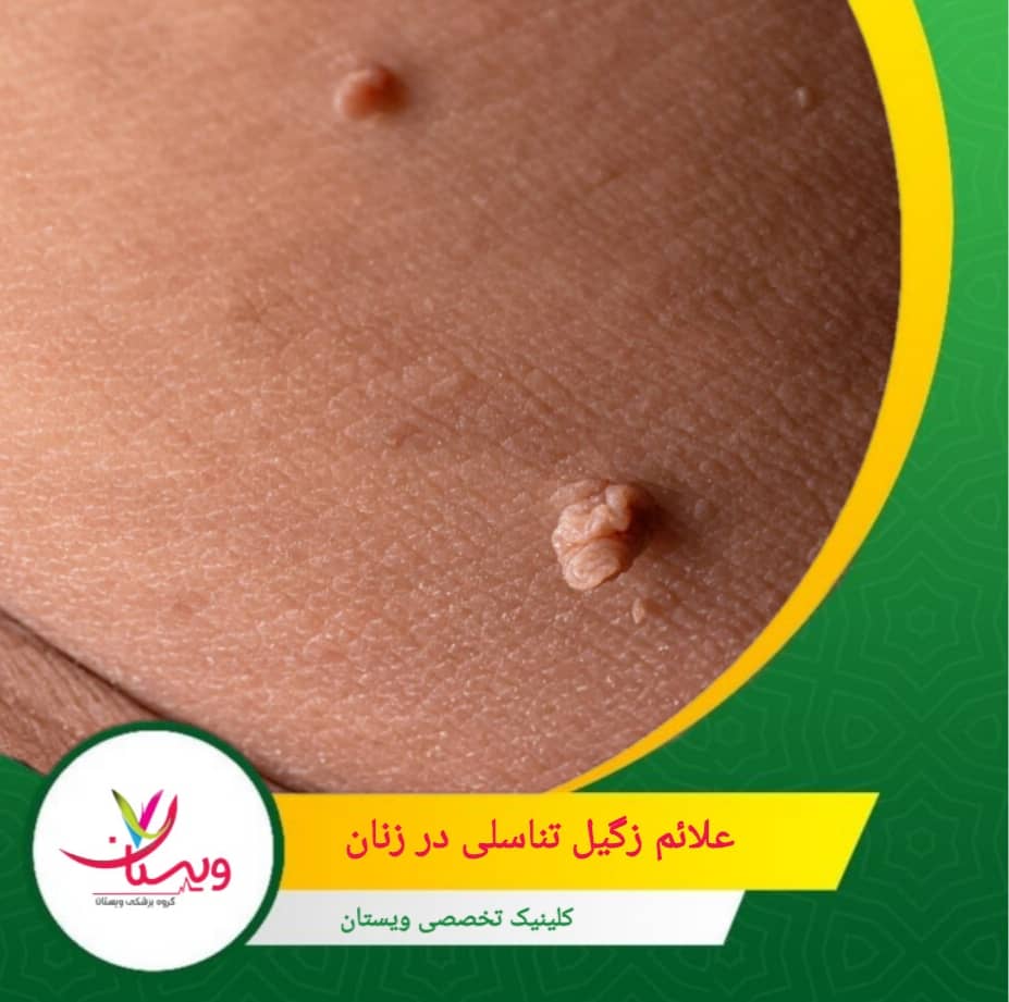 در موارد نادر، زگیلها ممکن است بزرگتر و برجستهتر شده و مشکلات بیشتری ایجاد کنند علائم زگیل تناسلی در زنان