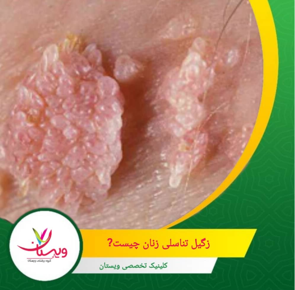 زگیل تناسلی زنان نوعی عفونت شایع مقاربتی (STI) است که از ویروس پاپیلومای انسانی یا HPV ناشی میشود. زگیل تناسلی زنان چیست؟