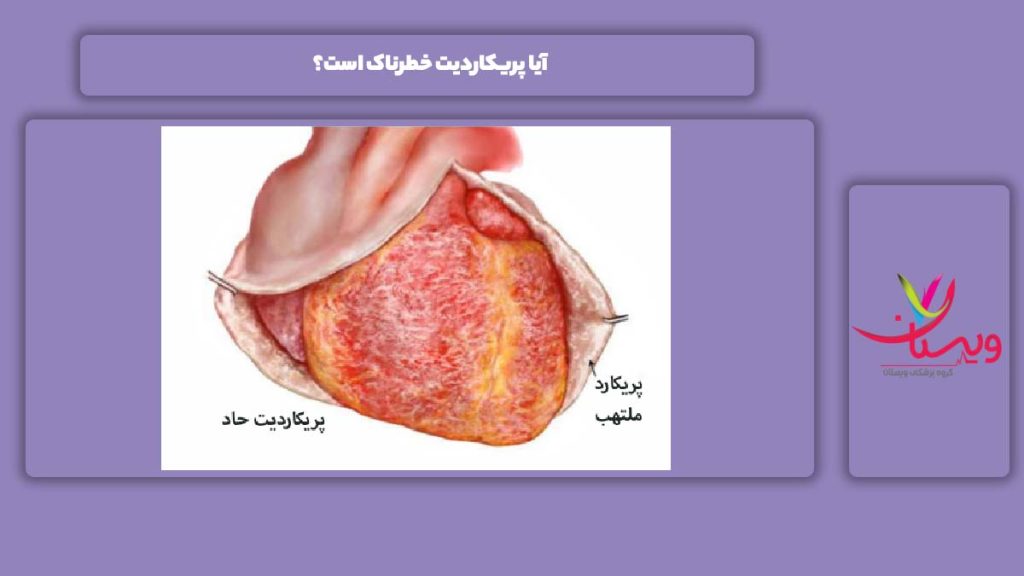 پر خطر بودن این بیماری آیا پریکاردیت خطرناک است؟