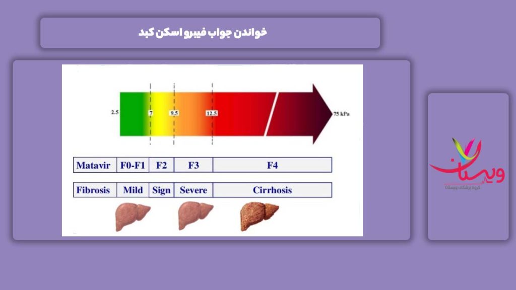 نحوه خواندن جواب فیبرواسکن خواندن جواب فیبرو اسکن کبد