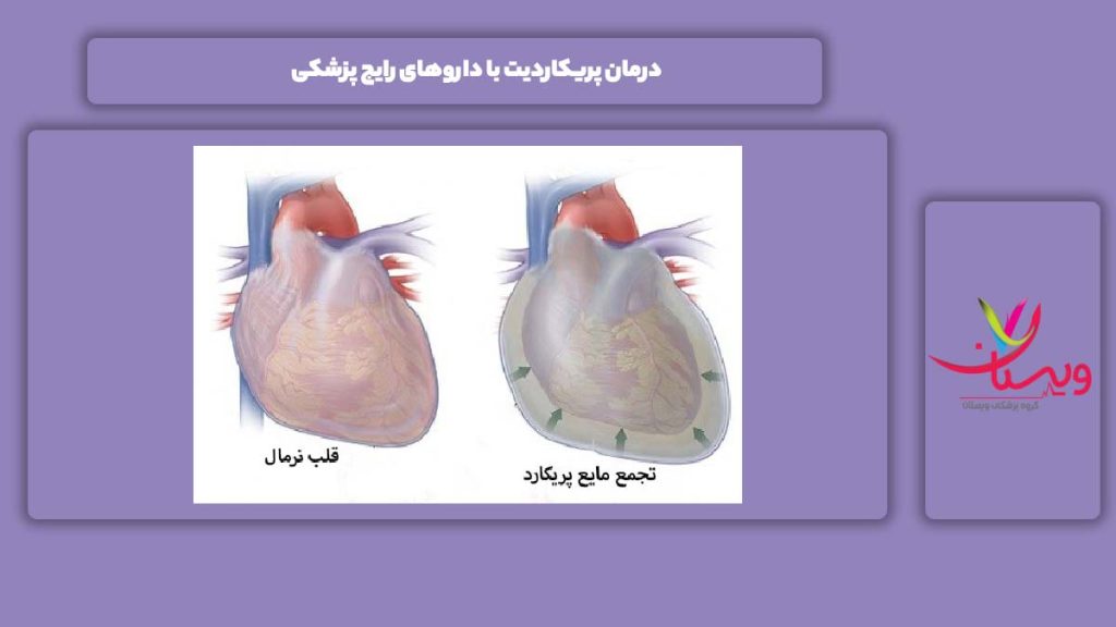 درمان پریکاردیت با داروهای پزشکی درمان پریکاردیت با داروهای رایج پزشکی