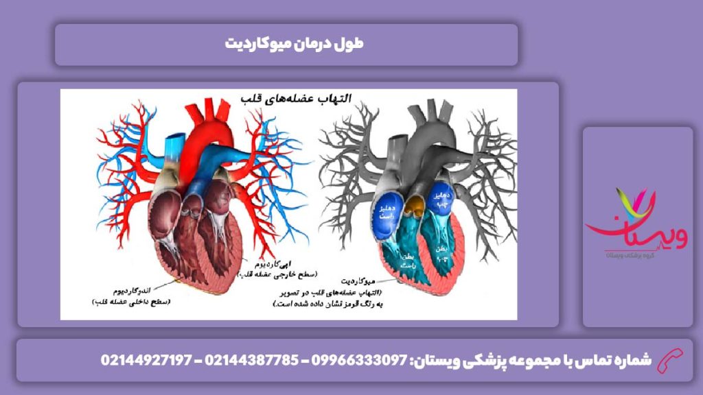 زمان مدوا شدن میوکاردیت درمان میوکاردیت