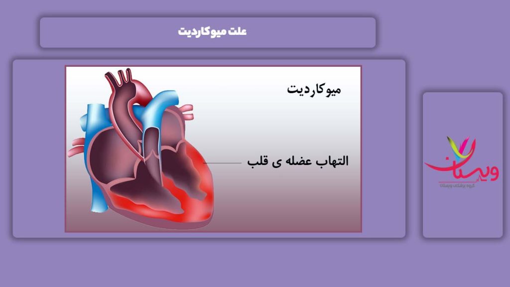 علت به وجود آمدن بیماری میوکاردیت درمان میوکاردیت
