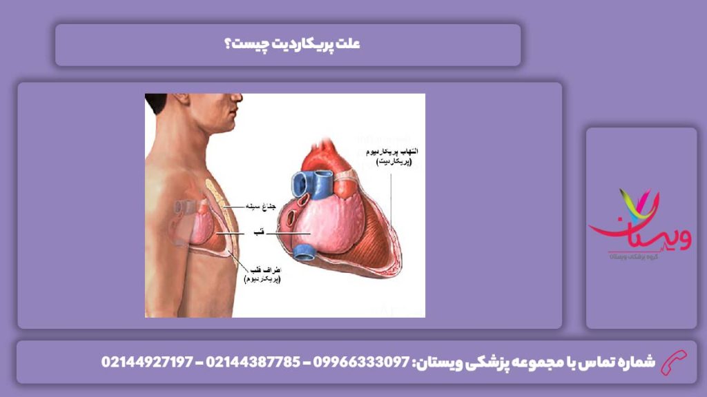 عامل به وجود آمدن پریکاردیت درمان پریکاردیت