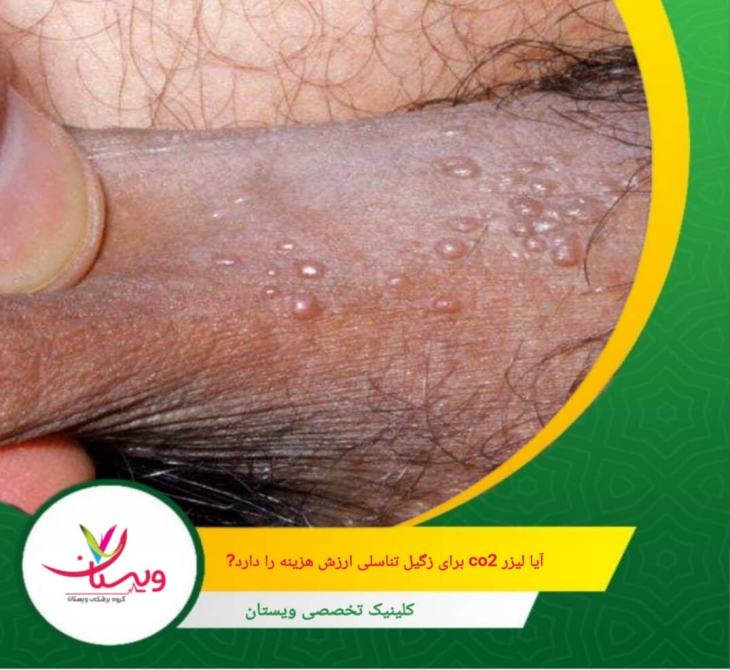 روش هایی مانند داروهای موضعی یا کرایوتراپی هزینه اولیه کمتری دارند، اما مؤثر نبوده و به جلسات مکرر نیاز دارند. آیا لیزر CO2 برای زگیل تناسلی ارزش هزینه را دارد؟