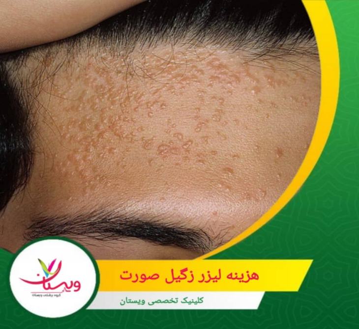 هزینه لیزر زگیل صورت به عواملی مانند تعداد زگیلها، اندازه آنها و نوع دستگاه لیزر بستگی دارد. هزینه لیزر زگیل صورت چقدر است؟