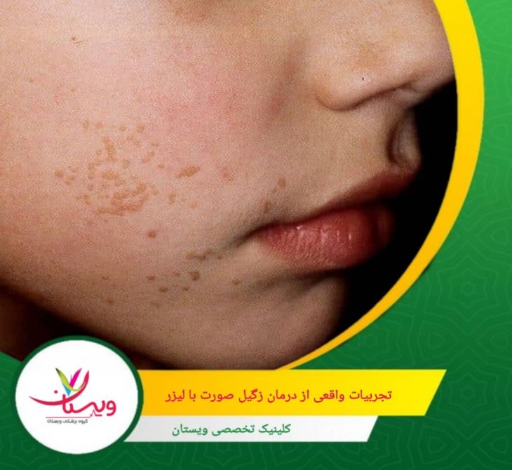 برخی از بیماران احساس گرما یا سوزش خفیفی در حین درمان داشتهاند که به سرعت برطرف شده است. تجربیات واقعی از درمان زگیل صورت با لیزر