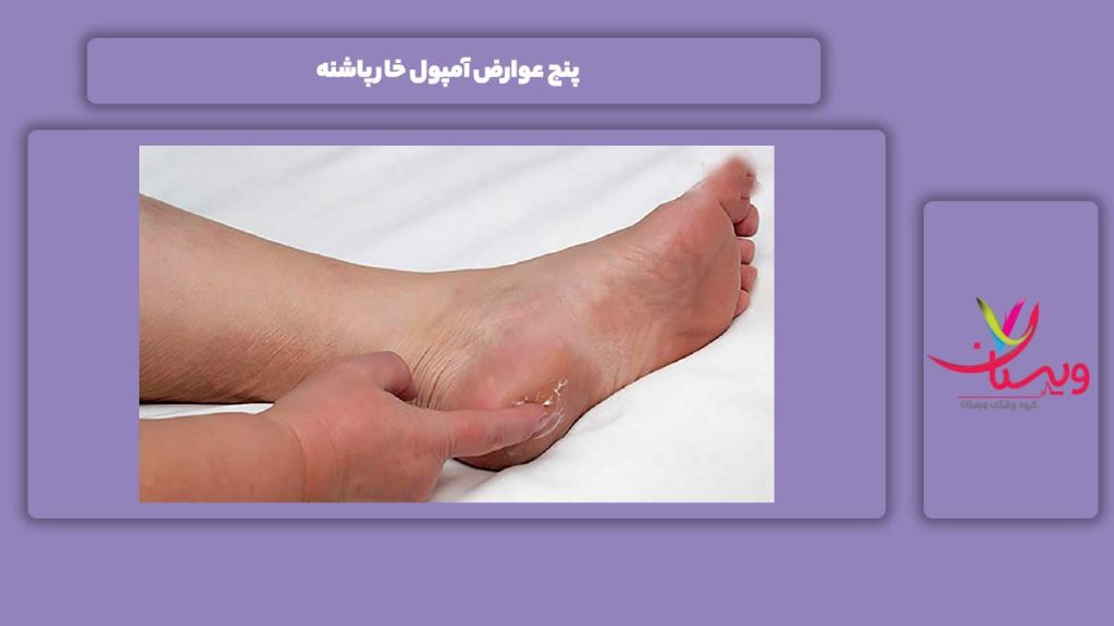 عوارض شایع آمپول برای این مریضی 5 عوارض آمپول خار پاشنه