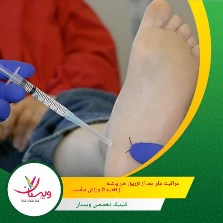 مراقبتهای بعد از تزریق خار پاشنه: از تغذیه تا ورزش مناسب