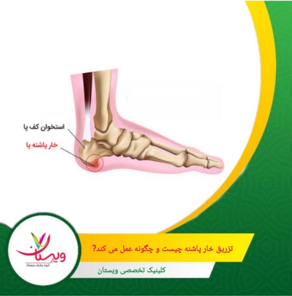 تزریق خار پاشنه نه تنها به کاهش التهاب کمک میکند، بلکه به بیمار این امکان را میدهد تا با کاهش درد، فعالیتهای روزمره خود را با راحتی بیشتری انجام دهد. تزریق خار پاشنه چیست و چگونه عمل میکند؟