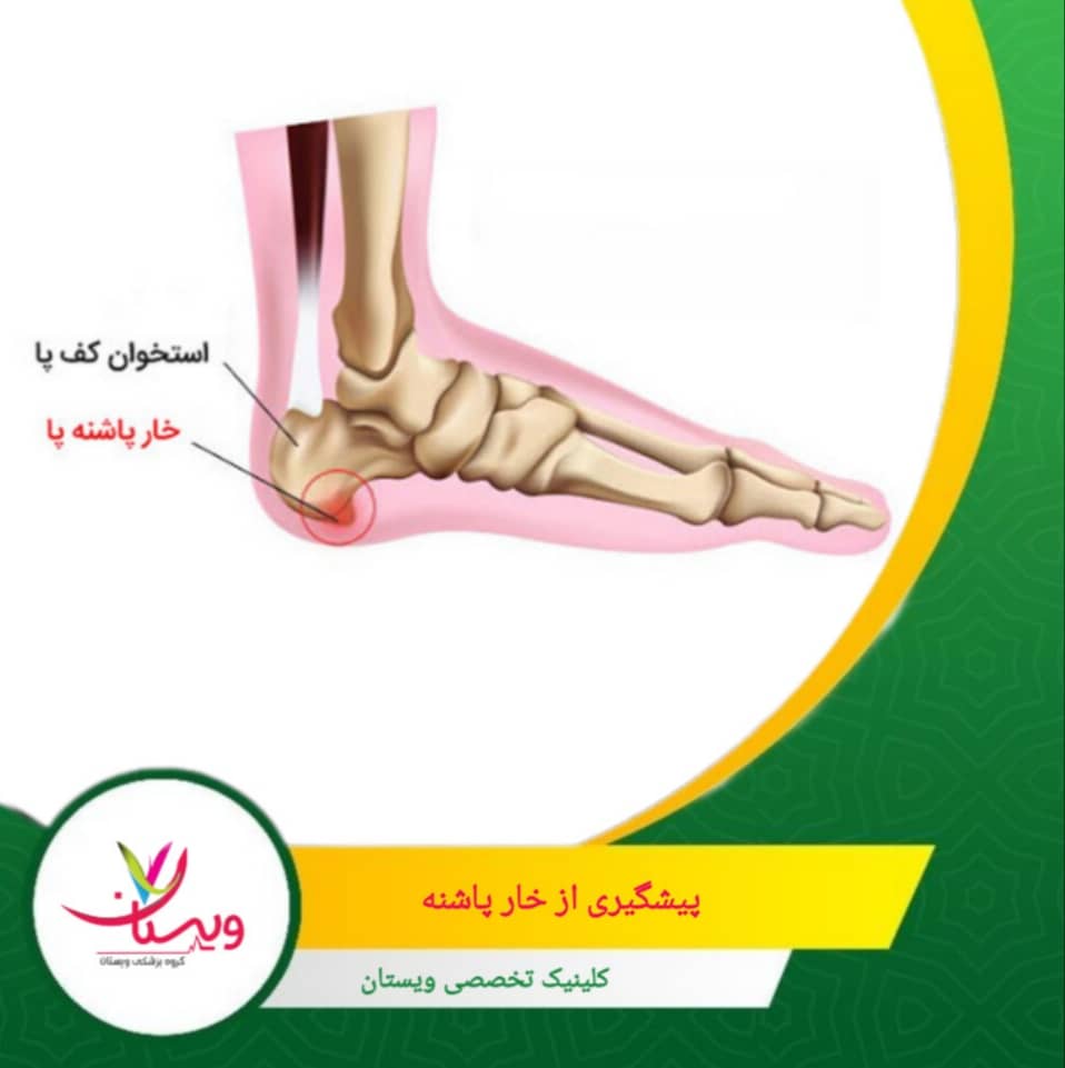 وزن اضافی فشار زیادی به کف پا وارد میکند. کاهش وزن میتواند به پیشگیری از التهاب نیام کف پا کمک کند. پیشگیری از خارپاشنه