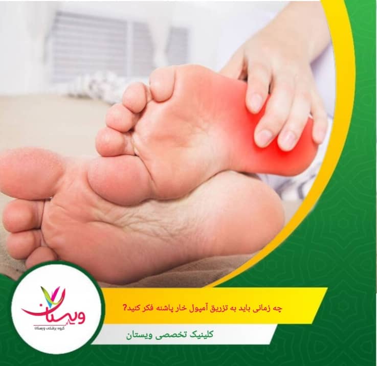در شرایطی که التهاب نیام کف پا (فاشیای پلانتار) بسیار شدید است و سایر روشها قادر به کنترل آن نیستند، تزریق کورتیکواستروئیدها توصیه میشود. چه زمانی باید به تزریق آمپول خارپاشنه فکر کنید؟