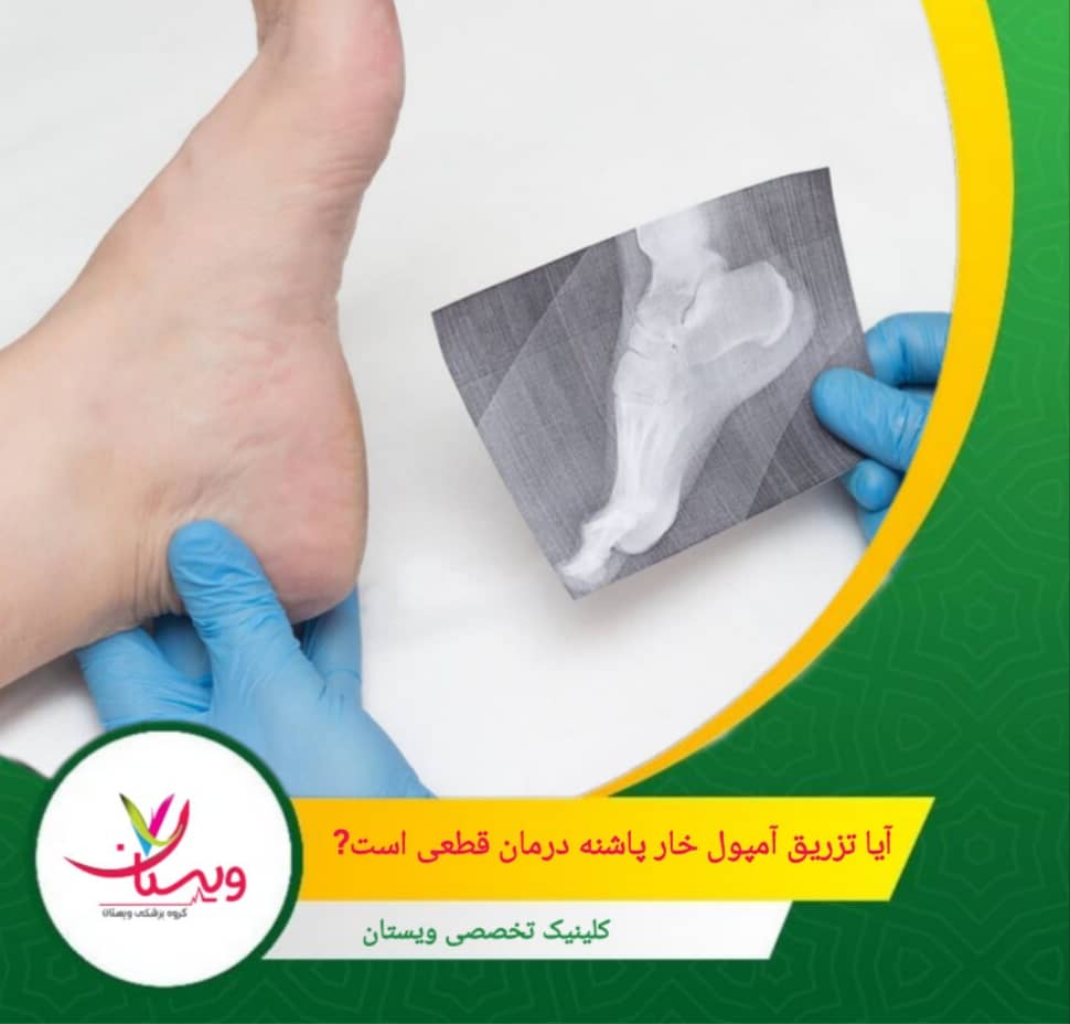 برای جلوگیری از عود علائم، ترکیب این روش با درمانهای مکمل مانند فیزیوتراپی، کفی طبی و تمرینات کششی ضروری است. آیا تزریق آمپول خارپاشنه درمان قطعی است؟