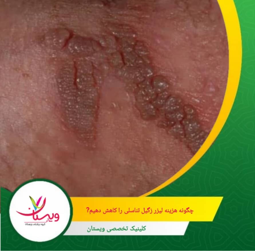 پیشگیری از بازگشت زگیلها، از راه های کاهش هزینه ها است. چگونه هزینه لیزر زگیل تناسلی را کاهش دهیم؟