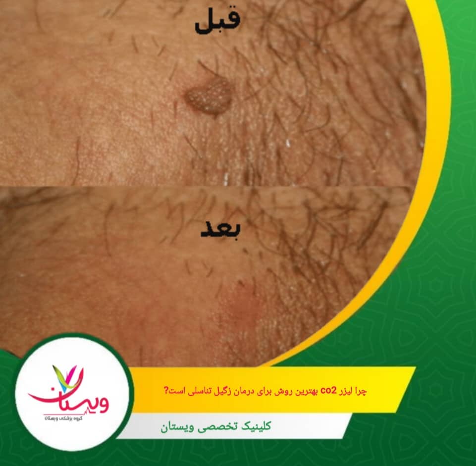 دقت بالا و آسیب کم، لیزر را برای درمان زگیل های مقاوم یا واقع در نواحی حساس ایده آل می کند. چرا لیزر CO2 بهترین روش برای درمان زگیل تناسلی است؟