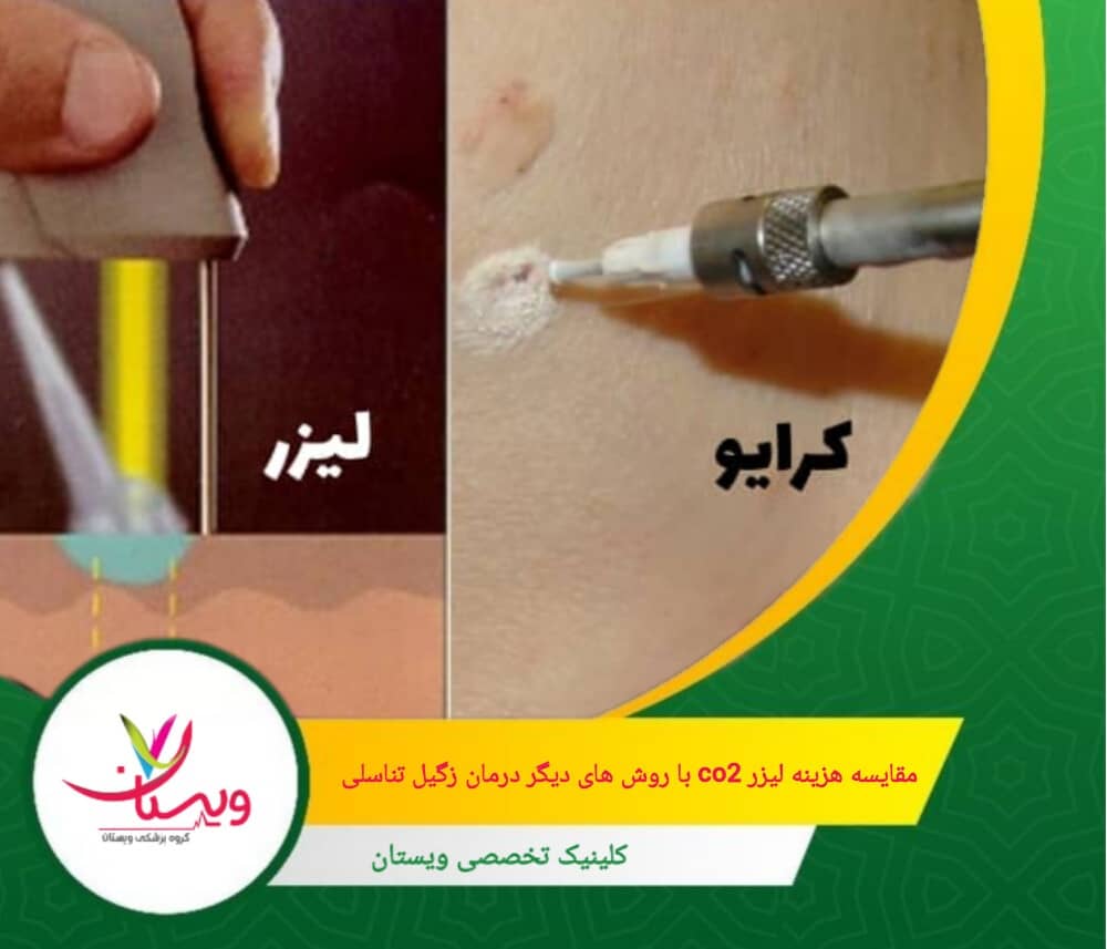 هزینه لیزر CO2 برای هر ضایعه، 500 هزار تومان است. مقایسه هزینه لیزر CO2 با روشهای دیگر درمان زگیل تناسلی
