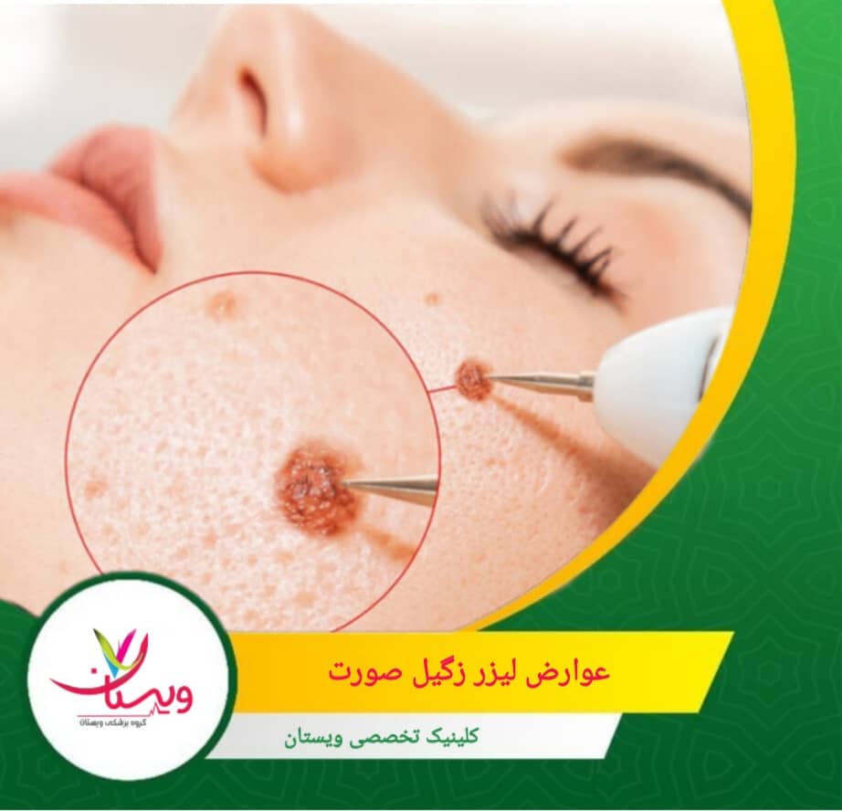 پوست پس از لیزر حساستر میشود و نیاز به استفاده از کرم ضدآفتاب با SPF بالا دارد. عوارض لیزر زگیل صورت