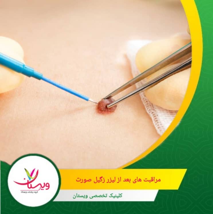 پزشک ممکن است کرمهای ترمیمکننده یا آنتیبیوتیک موضعی تجویز کند. مراقبتهای بعد از لیزر زگیل صورت