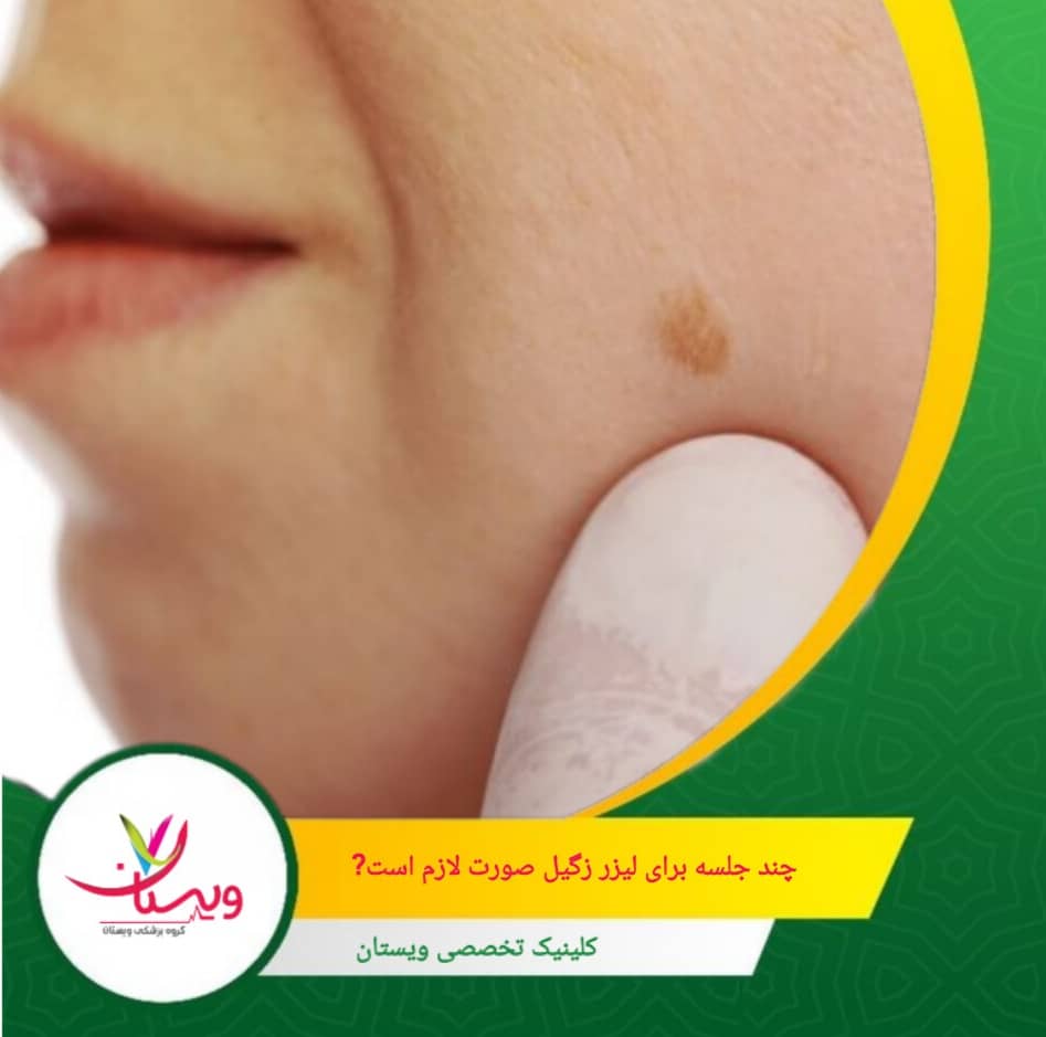 رای زگیلهای بزرگتر یا مقاوم، ممکن است جلسات بیشتری نیاز باشد. مشاوره با پزشک متخصص بهترین راه برای تعیین تعداد دقیق جلسات است. چند جلسه برای لیزر لازم است؟