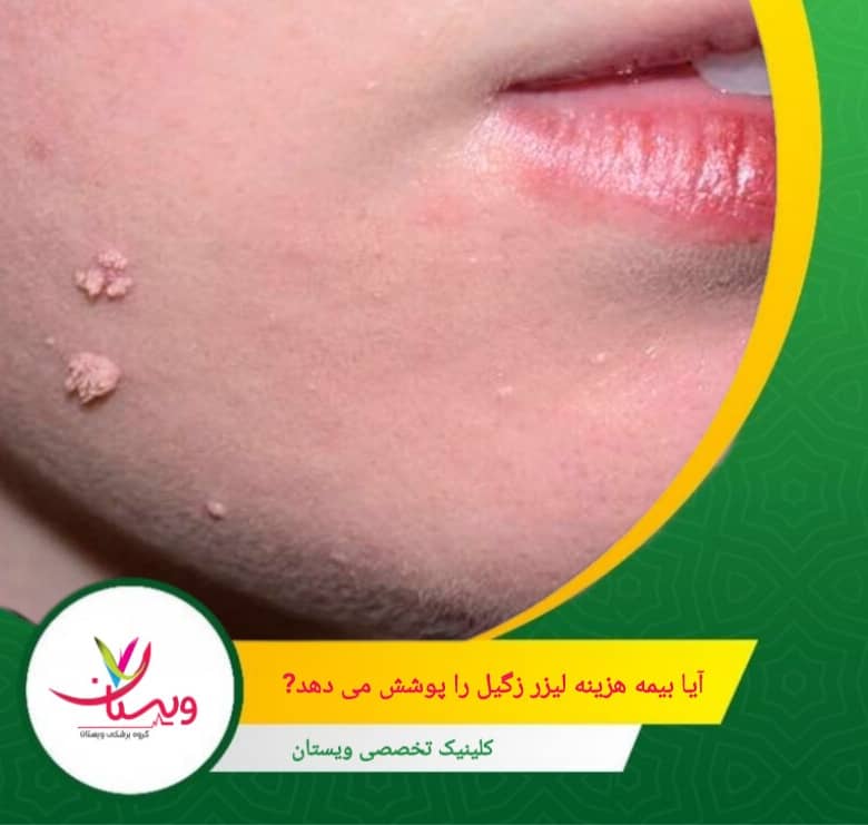 پوشش بیمه برای لیزر زگیل صورت به عوامل مختلفی بستگی دارد، از جمله نوع بیمه، ضرورت پزشکی درمان و طبقهبندی آن. آیا بیمه هزینه لیزر زگیل را پوشش میدهد؟