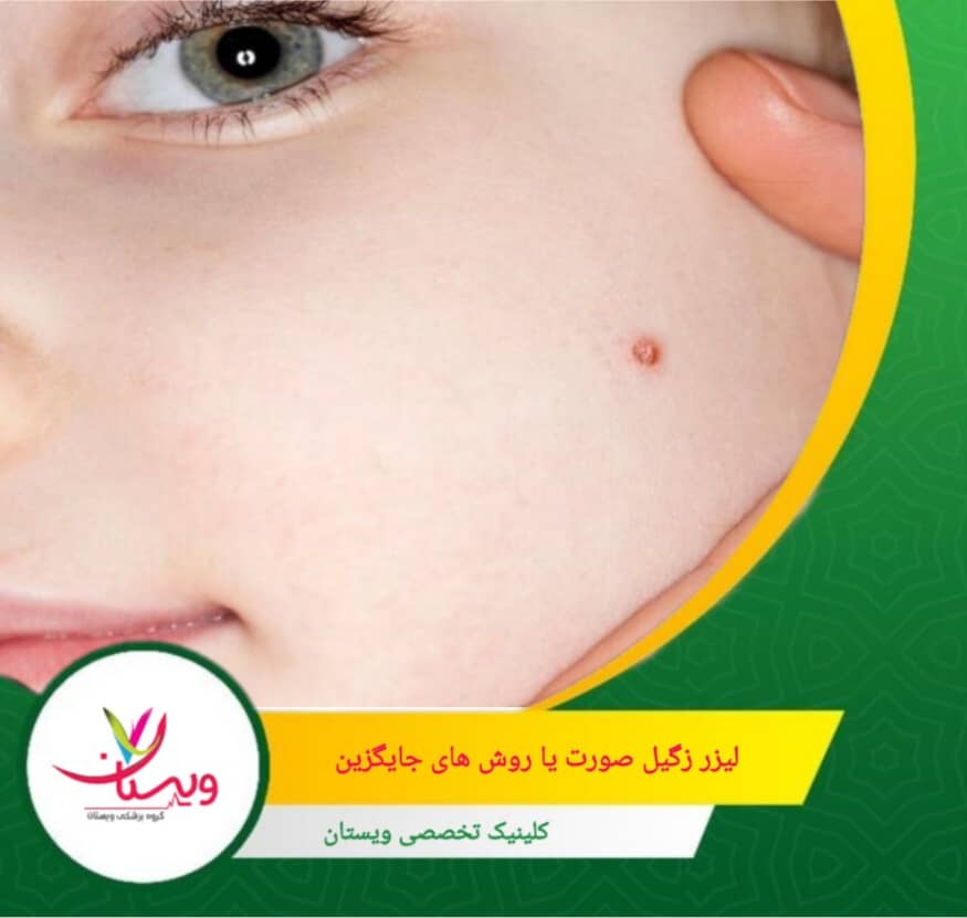 لیزر با استفاده از پرتوهای متمرکز، زگیل را بهطور دقیق و سریع از بین میبرد. لیزر زگیل صورت یا روشهای جایگزین؟