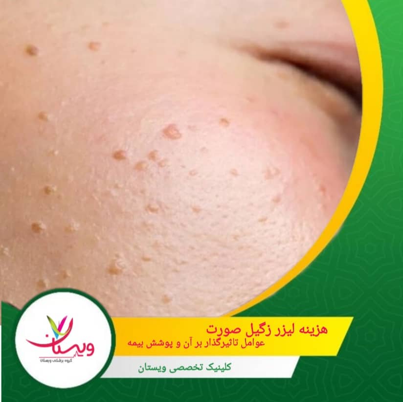 هزینه لیزر زگیل صورت | عوامل تاثیرگذار بر آن و پوشش بیمه