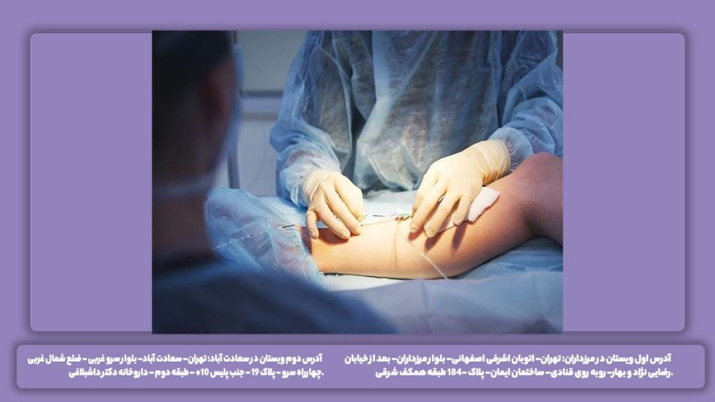 عمل رگهای واریسی پا لیزر رگهای واریسی پا