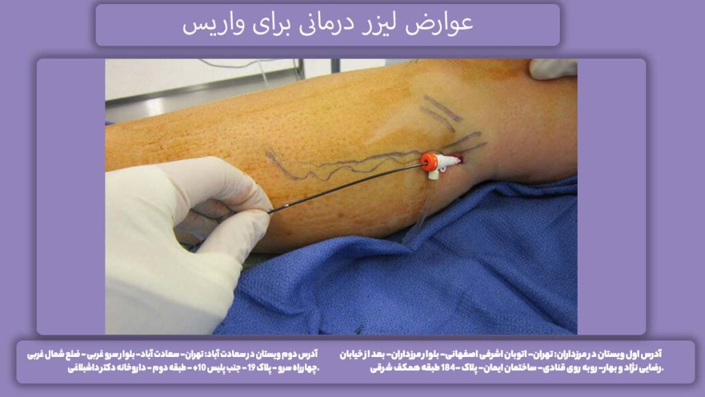 خطرات واریس با لیزر عوارض لیزر واریس کدامند؟