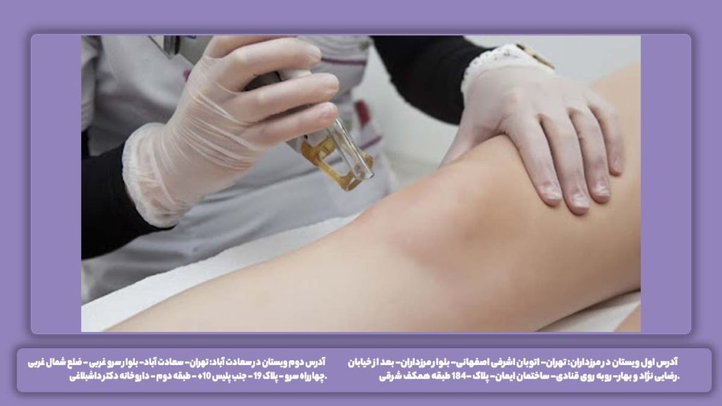 مراکز دولتی لیزر واریس نرخ دولتی لیزر درمانی