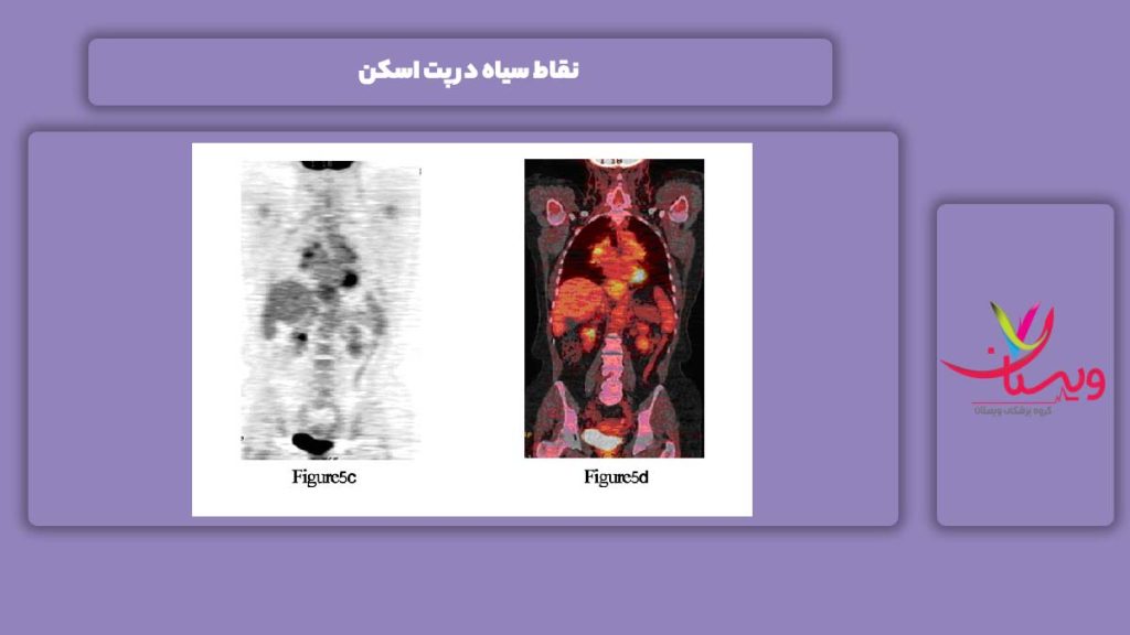علت نقطه سیاه در پت اسکن نقاط سیاه در پت اسکن