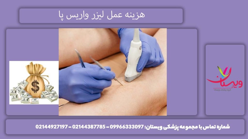 هزینه لیزر واریس پا در تهران