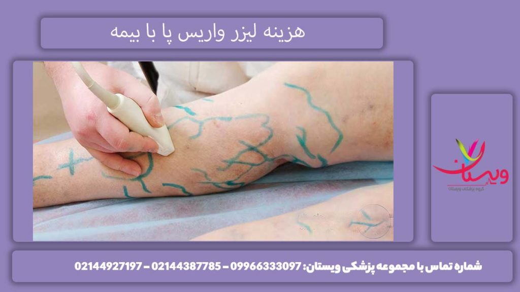 لیزر وارسی با پوشش بیمه هزینه لیزر واریس پا با پوشش بیمه