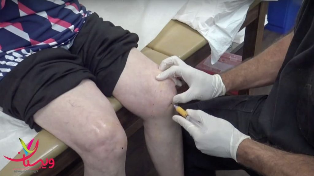 تزریق سلول بنیادی جهت درمان آرتروز زانو درمان آرتروز زانو با سلول های بنیادین در بیمار مسن