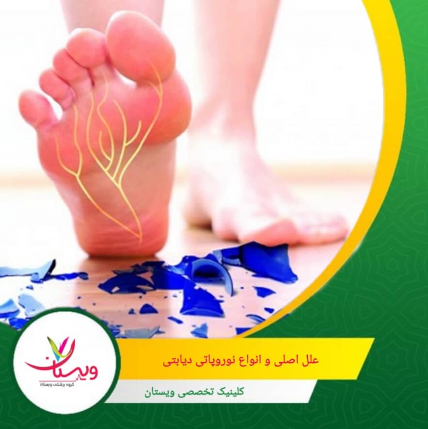 نوروپاتی محیطی: شایعترین نوع. ابتدا اعصاب پا را درگیر کرده و بهمرور به دست و بازوها گسترش مییابد. علل اصلی و انواع نوروپاتی دیابتی