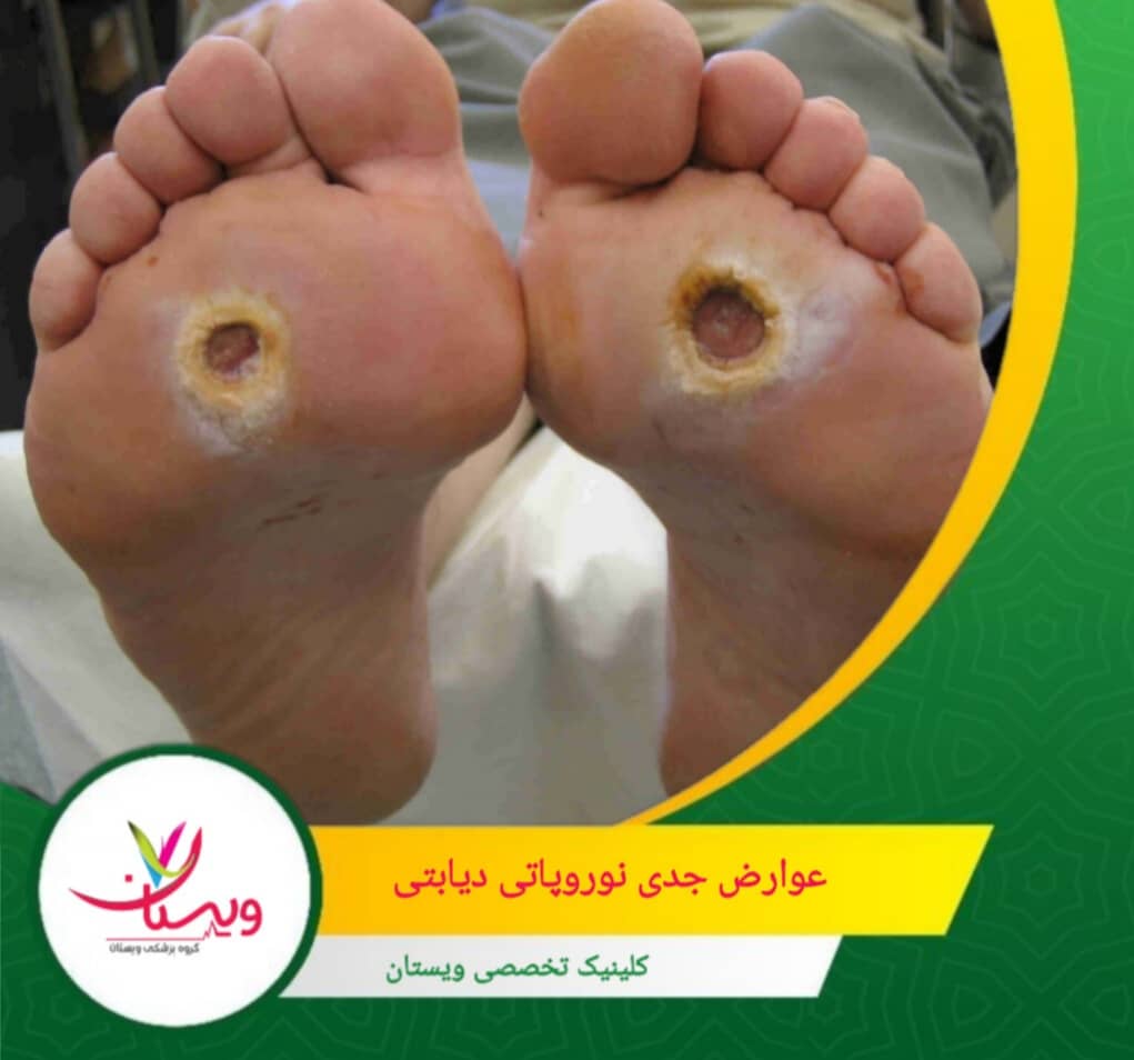 در موارد پیشرفته که عفونتها کنترل نشوند، نیاز به قطع انگشتان یا حتی قسمتهایی از پا پیش میآید که عواقب جسمی و روانی سنگینی دارد. عوارض جدی نوروپاتی دیابتی