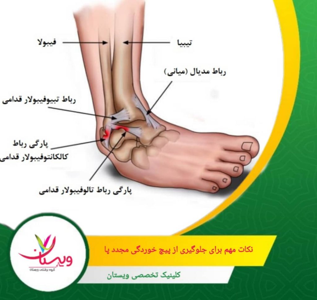 بهخصوص در مراحل بازگشت به ورزش یا فعالیتهای پرخطر، حمایت اضافی میتواند از آسیب جلوگیری کند. نکات مهم برای جلوگیری از پیچخوردگی مجدد مچ پا