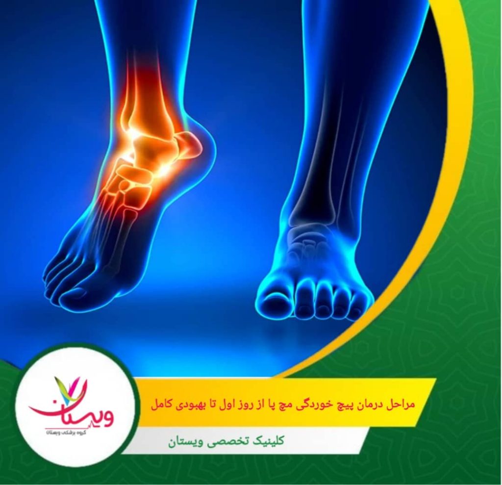 مراحل درمان پیچخوردگی مچ پا از روز اول تا بهبودی کامل