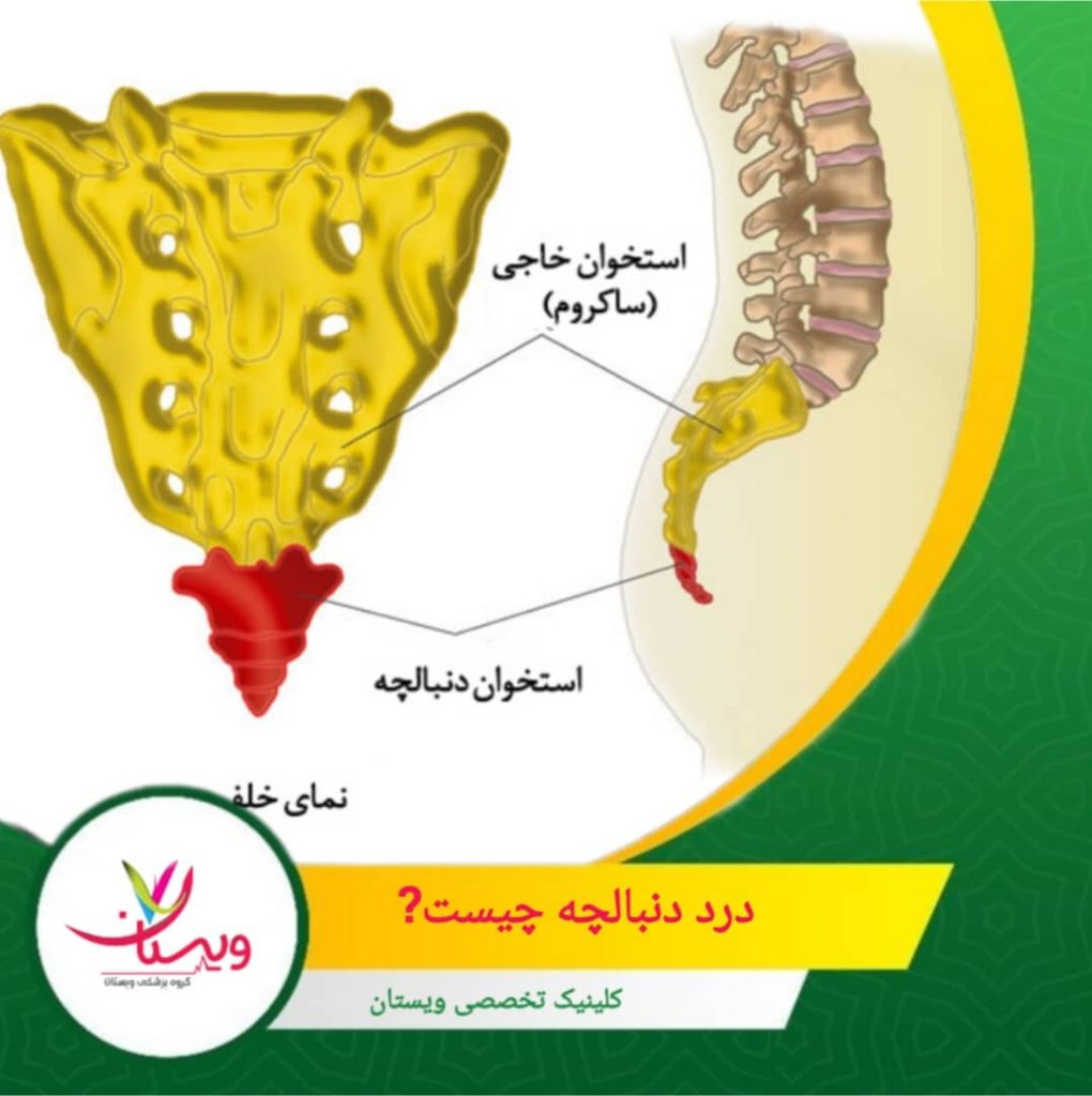 در برخی موارد، علت مشخصی پیدا نمیشود. شناخت دقیق علت درد دنبالچه برای انتخاب درمان مناسب اهمیت زیادی دارد. درد دنبالچه چیست؟