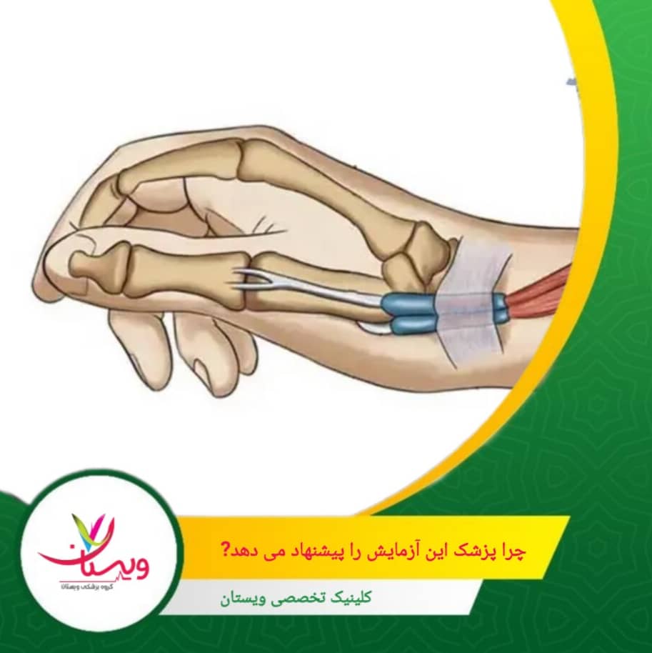 این تست یک روش سریع، دقیق و غیرتهاجمی برای بررسی التهاب تاندونهای اطراف شست، بهویژه عضلات Extensor Pollicis Brevis و Abductor Pollicis Longus است. چرا پزشک این آزمایش را پیشنهاد میدهد؟