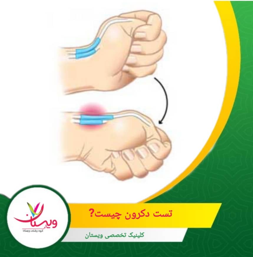 این روش به دلیل حساسیت و دقت بالا، یکی از اصلیترین ابزارهای پزشکان و فیزیوتراپیستها برای تشخیص زودهنگام محسوب میشود. تست دکرون (فینکلاشتاین) چیست؟