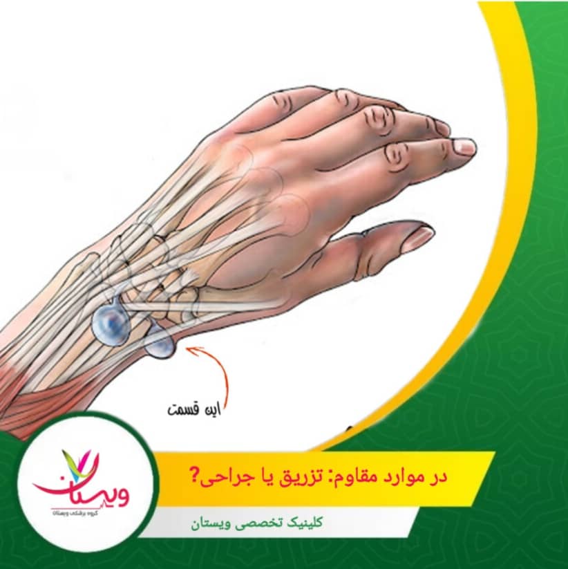 معمولاً ابتدا روشهای کمتهاجمی امتحان میشوند و در صورت مقاومت، جراحی انتخاب میشود. در موارد مقاوم: تزریق یا جراحی؟