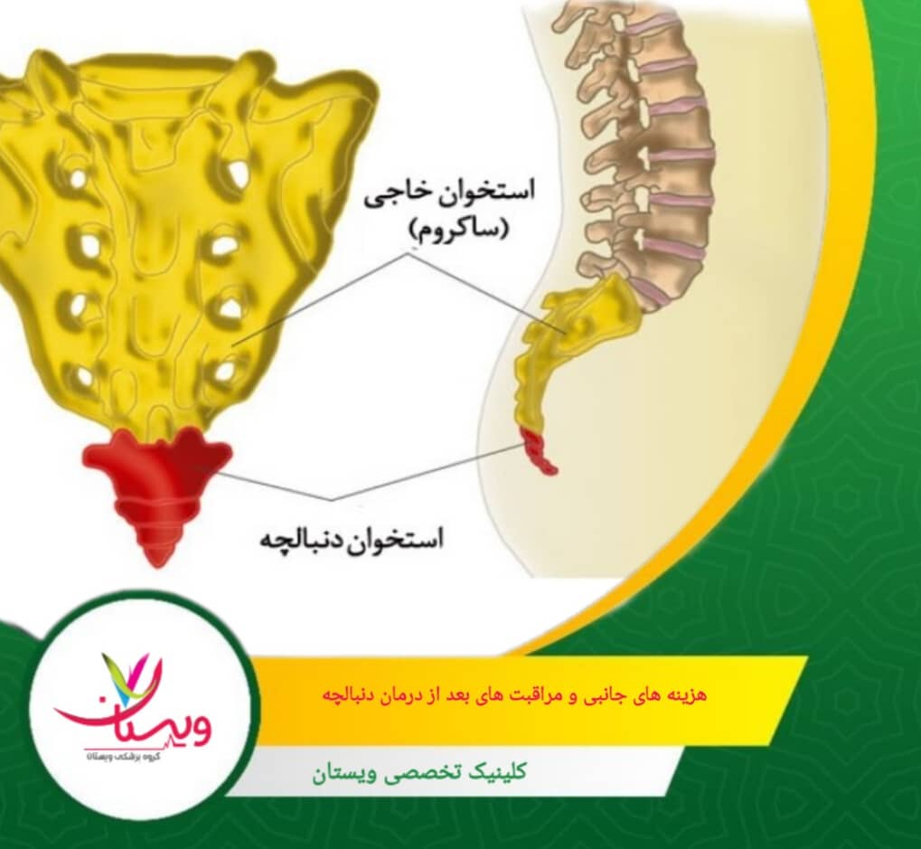 پیگیری دقیق و به موقع جلسات ویزیت پزشک برای اطمینان از ترمیم صحیح دنبالچه. هزینههای جانبی و مراقبتهای بعد از درمان دنبالچه