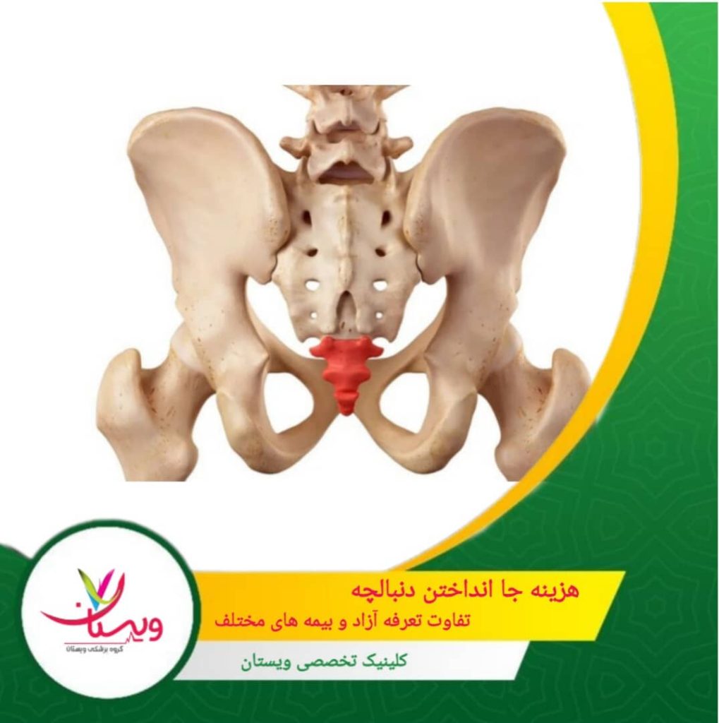 هزینه جا انداختن دنبالچه| تفاوت تعرفه آزاد و بیمه های مختلف