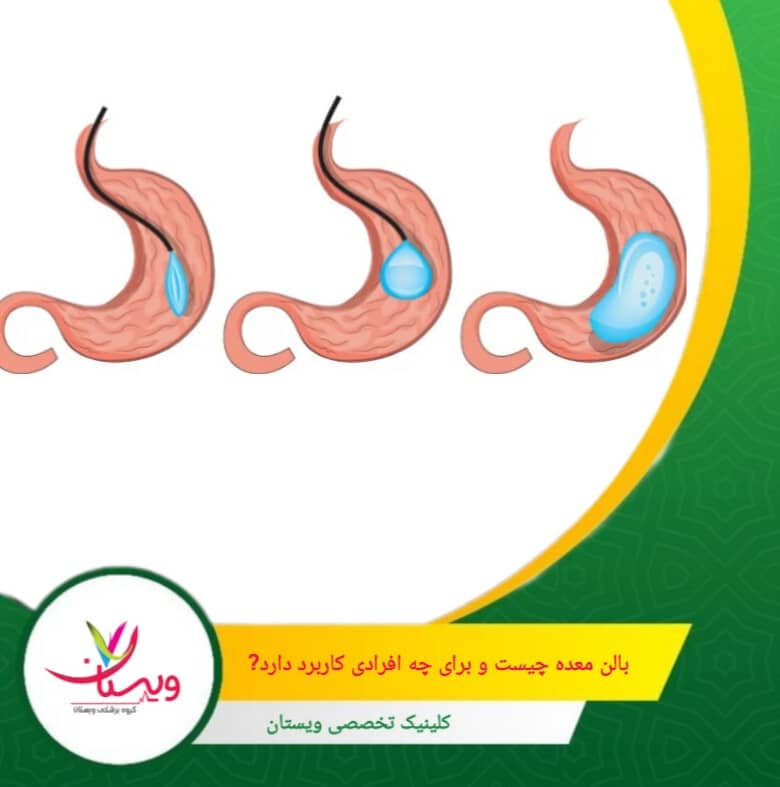 کسانی که با وجود تلاشهای مکرر در رژیم و ورزش به نتیجه مطلوب نرسیدهاند. بالن معده چیست و برای چه افرادی کاربرد دارد؟