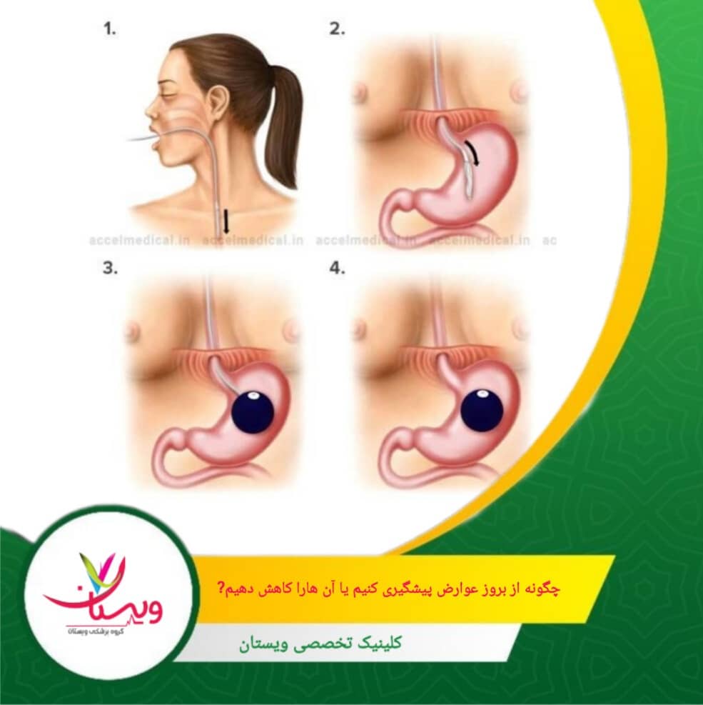 ورزش منظم، خواب کافی و کنترل استرس به بدن کمک میکند تا بهتر با تغییرات معده سازگار شود و کاهش وزن سالم داشته باشید. چگونه از بروز عوارض پیشگیری کنیم یا آنها را کاهش دهیم؟