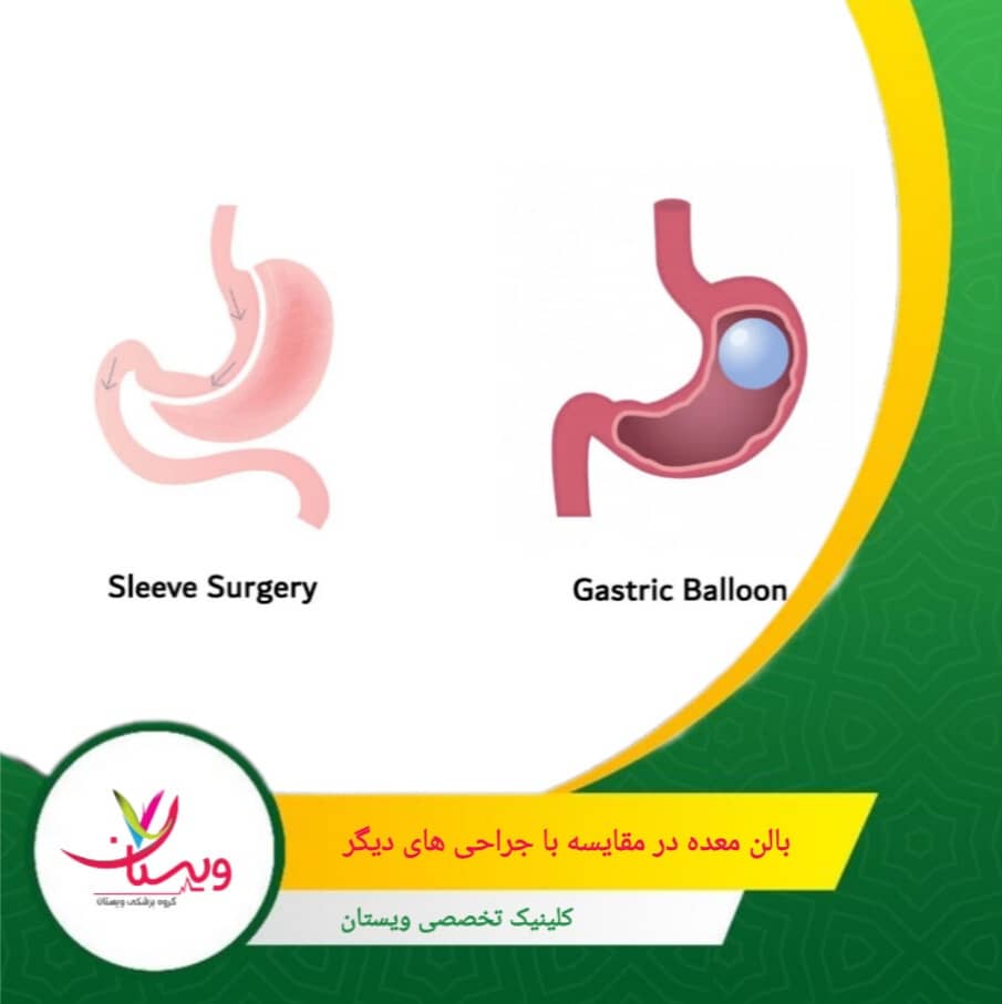 بالن معده معمولاً سرپایی یا یک شب بستری، ریکاوری سریع دارد. بالن معده در مقایسه با جراحیهای دیگر (مثل اسلیو یا بایپس)