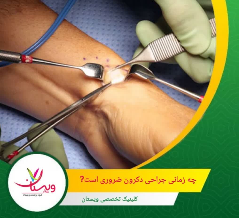 ویژگیهای آناتومیکی خاص، مانند تقسیم یا تنگی غلاف تاندون، باعث مقاومت در برابر درمانهای محافظهکارانه شوند. چه زمانی جراحی دکرون ضروری است؟