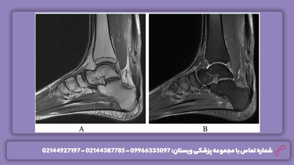 آسیب پارگی زردپی تاندون نشانههای پارگی تاندون پا را بشناسید